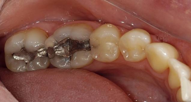 Restauration en composite (plombage blanc) – Lixus Smile