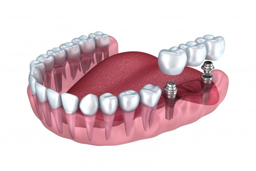 Bridge sur implants