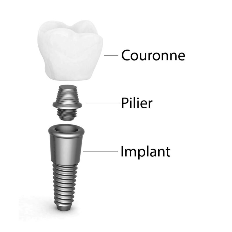 Couronne sur implants (implant unitaire) Lixus Smile