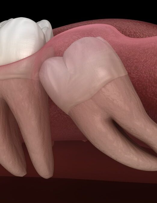 Extraction_dents_de_sagesse_Anjou-1000×675