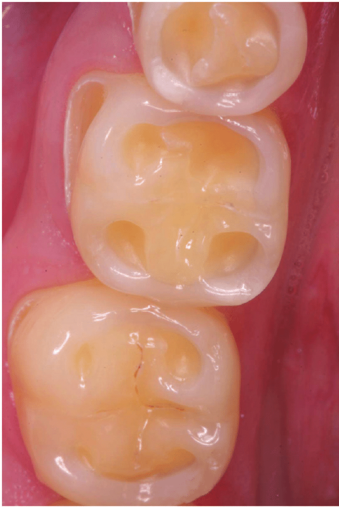 Lower-molar-and-premolar-teeth-of-a-patient-with-nocturnal-reflux-The-normal-occlusal