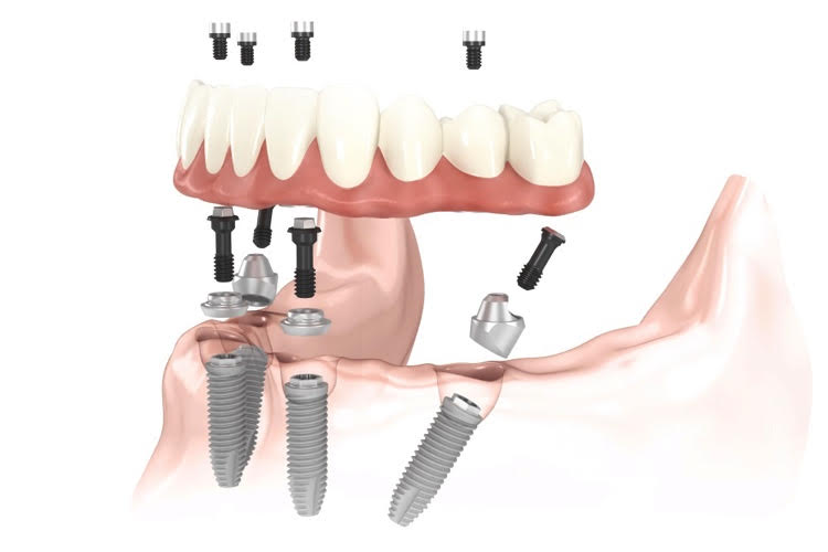 Prothèse totale sur implant (All on 4)