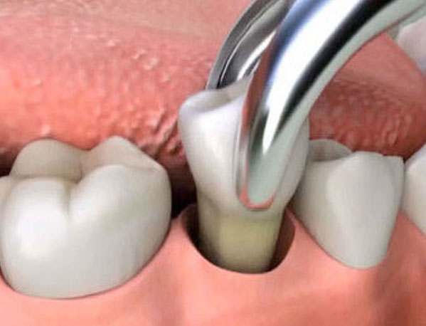 Tooth-Extractions-Parker-Family-Dental