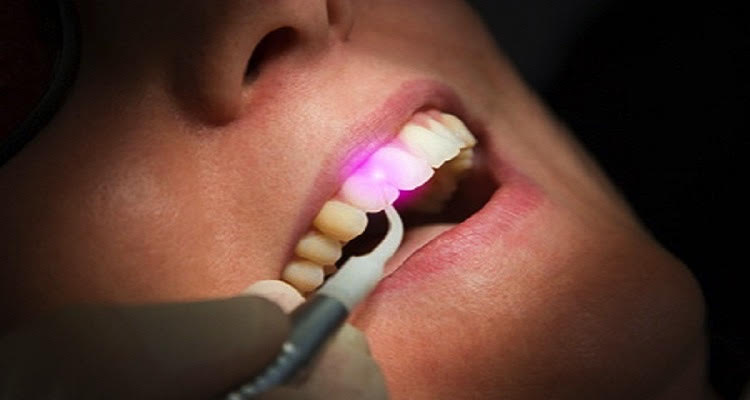 Traitements au laser