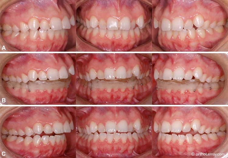 articulation-plaque-occlusale-malocclusion-113098-VG26