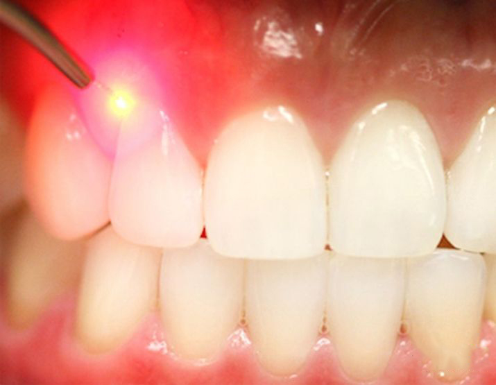 dents-laser_01587892