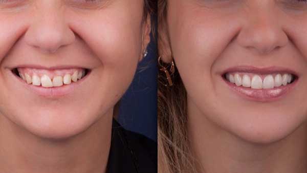 docteur-marc-chouraki-chirurgien-dentiste-paris-8-chirurgie-couronne-ceramo-ceramique-2