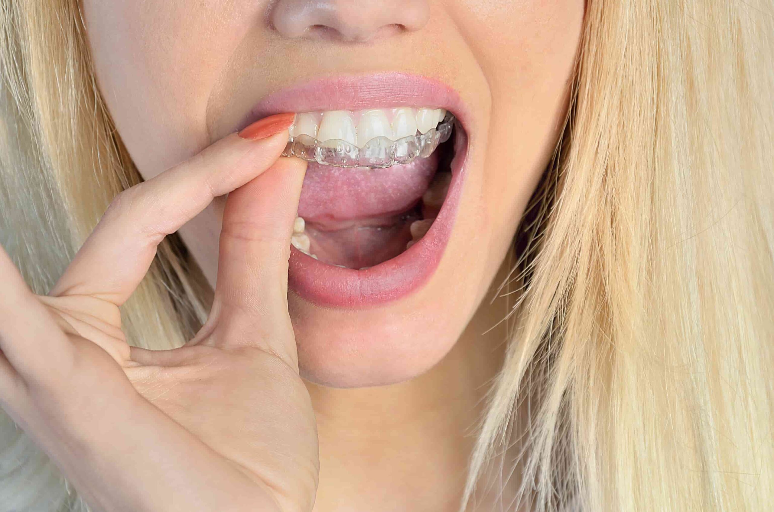 femme-avec-protecteur-buccal-plaque-occlusale-transparent