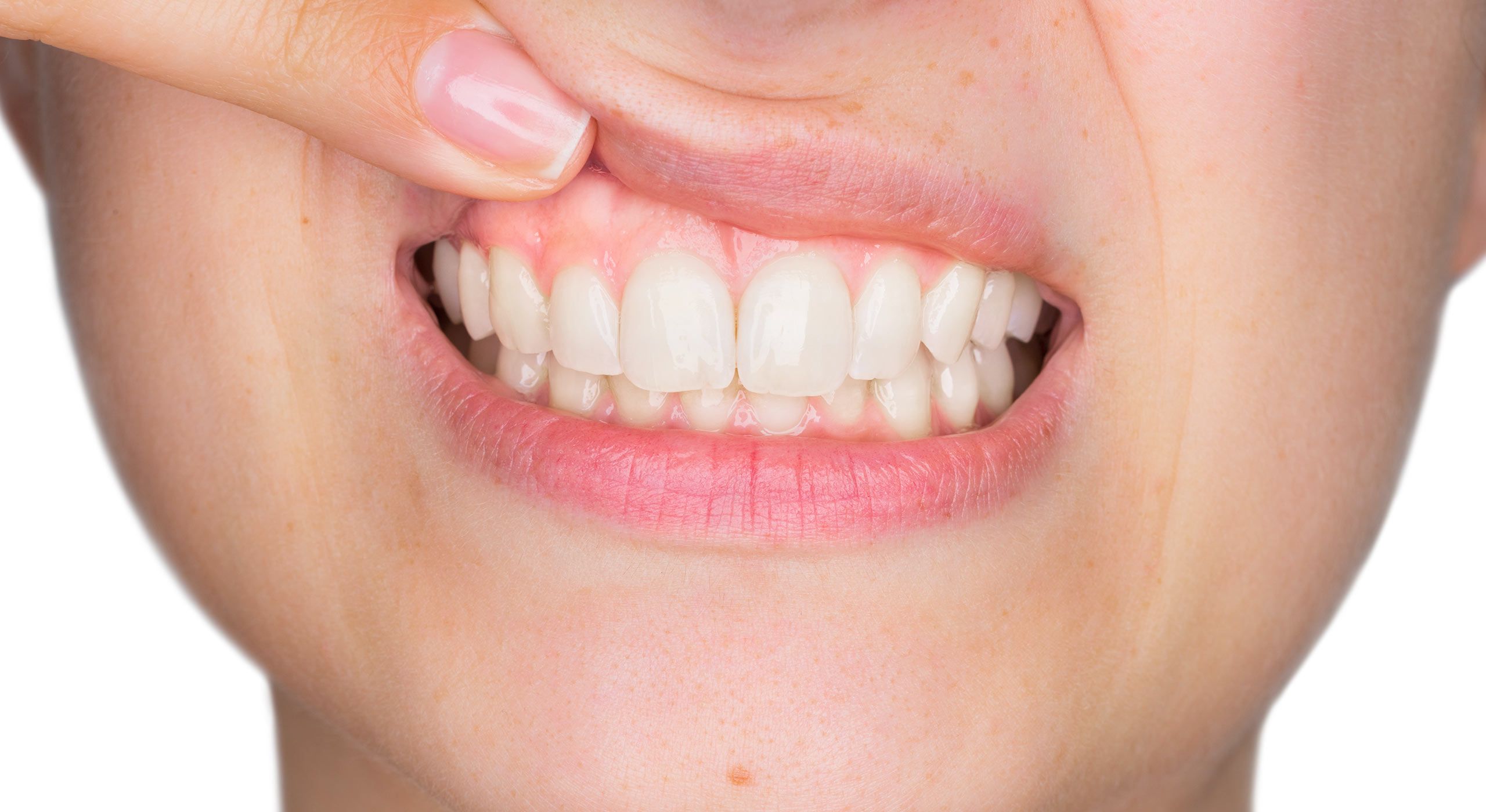gingivectomie-dr-morgane-cohen-chirurgien-dentiste