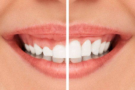gingivectomie-tunisie