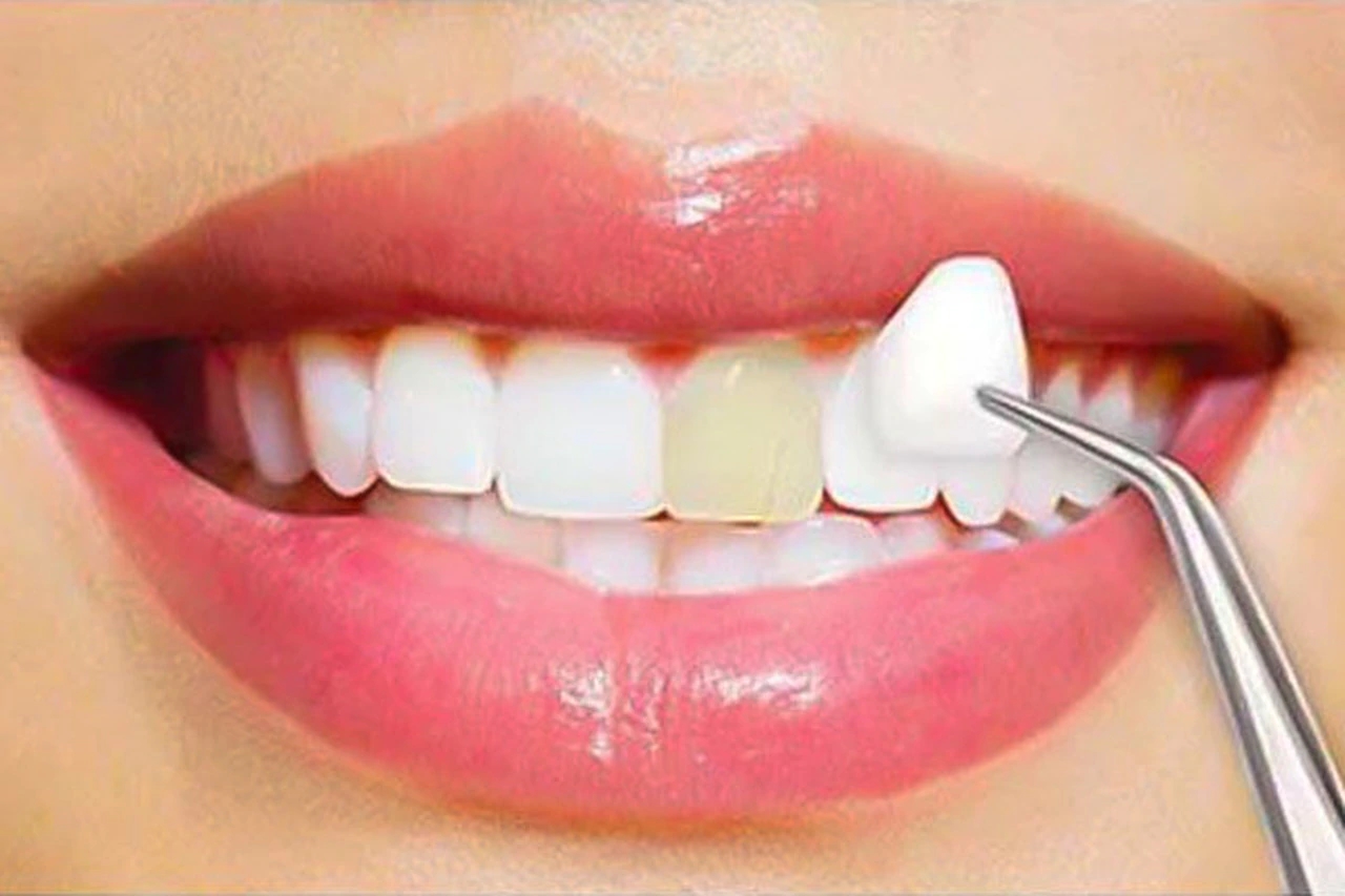 porcelain-veneers-by-dentist-in-ann-arbor-and-ypsilanti-ypsi-washtenaw-michigan-at-dental-house__60952.1560116019