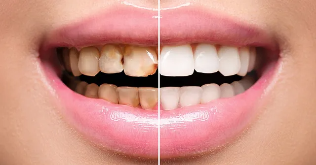teeth-before-and-after-640w