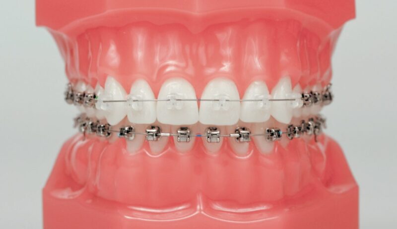 Damon Technique – Lixus Smile – Larache