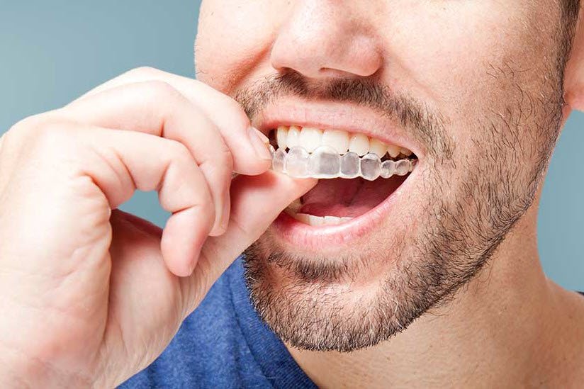Invisalign – Lixus Smile – Larache – Maroc