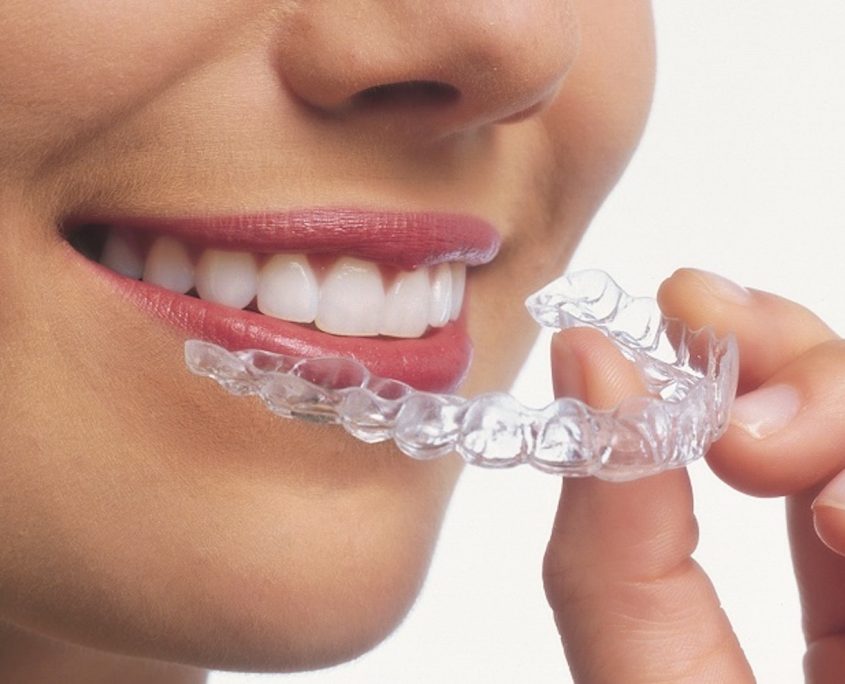 Invisalign-O2dental-dentist-larache