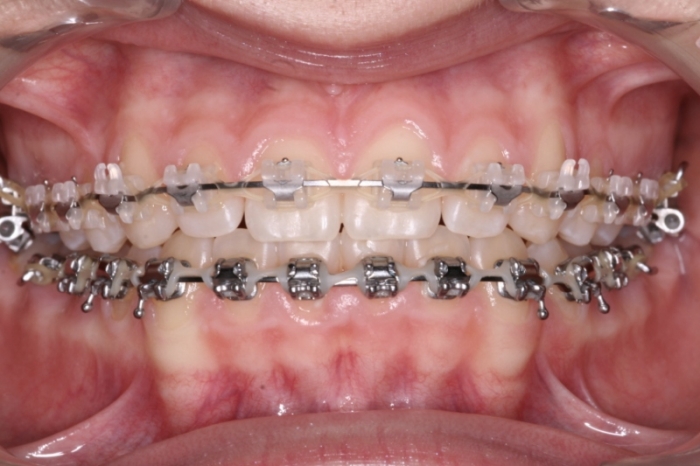 Les broches permettent de corriger individuellement et simultanément la position des dents