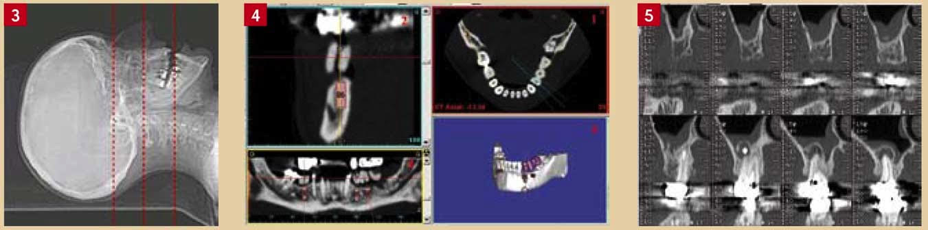 Scanner 3D cone beam – Lixus Smile – Larache – 3