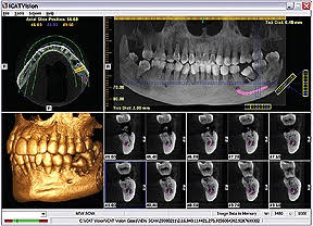 Scanner 3D cone beam – Lixus Smile – Larache – 4